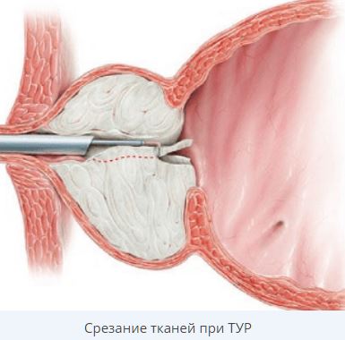 Implantátumos kezelés prosztata-megnagyobbodásban